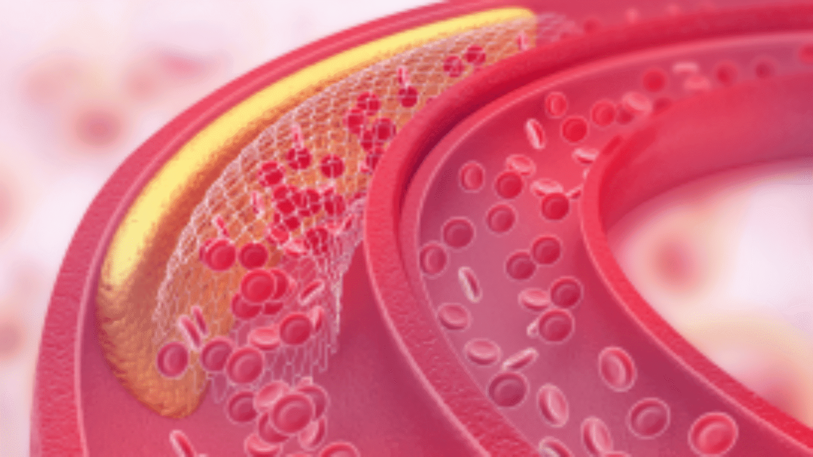 Behandeling van hypercholesterolemie